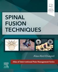 Spinal Fusion Techniques